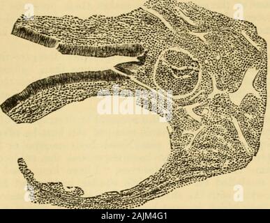 Un manuale di malattie del naso e della gola : compresa la faringe, la laringe, la trachea, l'esofago, naso e rinofaringe . igital esame anche in una sola volta consente al medico di riconoscere theirnature. Nonostante il numero di malattie con cui è possibile thatadenoid vegetazioni potrebbe essere confuso, ancora, tenendo considerationthe età del paziente e la marcata dei sintomi causati da le crescite,c'è praticamente molto poco la probabilità di un errore che si verifica. Patologia.-l'esame microscopico di questi naso faringeo growthsshows che esse consistono di forma cilindrica e a volte Foto Stock