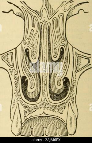 Un manuale di malattie del naso e della gola : compresa la faringe, la laringe, la trachea, l'esofago, naso e rinofaringe . Fig. 80.-In sezione verticale trasversale attraverso theNasal Fossae presso un punto dietro i primi denti molari(dopo Hirschfeld). La x in quattro punti diversi mostrale supposta origine di polypi. Fig. 81.-In sezione verticale trasversale della fossa nasale? Nel piano della BicuspidTeeth (dopo Hirschfeld). La x in corrispondenza di punti fourdifferent indica la presunta origine pointof di polypi. Il tema del distacco di una porzione di uno dei turbinated boneshas stati trattati qui perché th Foto Stock