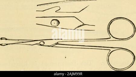 Un manuale di malattie del naso e della gola : compresa la faringe, la laringe, la trachea, l'esofago, naso e rinofaringe . Fig. 70.-Il prof. Gross1 Spuds nasale (dopo Solis-Cohen). il tubo. Il rubinetto deve quindi essere spento e lo strumento lasciato in situ come lungo come può sembrare auspicabile. Strumenti per la rimozione di corpi estranei dalla cavità nasali.-strumenti lordo mostrata nei disegni xilografia (Fig. 70), può trova utile. Essi sono costituiti da poco sessole, cavatappi di punti e di gancio consente a. Per l'estrazione di piccoli calcoli nasale, forcipe sottile (Fig. 71). Fig. 71.-pinzette per rimuovere la SMA Foto Stock