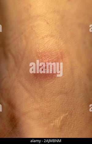Piaghe da decubito, ulcere da decubito ,ulcera pressione Foto stock - Alamy