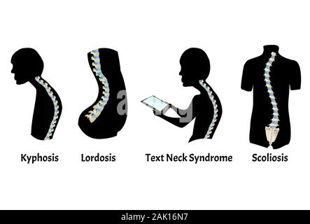 La posizione della colonna vertebrale con lordosi, cifosi. Testo Sindrome del collo. Curvatura spinale, cifosi, lordosi, scoliosi, artrosi. La cattiva postura e Illustrazione Vettoriale