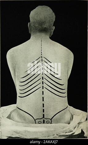 La tecnica di anestesia . a vantaggio. Non è necessario che il patientfast. La più soddisfacente sito di iniezione è compresa tra Laterza e la quarta vertebra lombare? Direttamente nell'middleline (Fig. 117). Lo scopo di questo sito di iniezione è toimmediately impegnare il muscolo ligamentum. Questo facili-tati l'ingresso diretto nel canale. Questo punto può essere trovato come segue: con la patientsitting fino in una postura slouching, tracciare una linea connectingboth creste iliache. Questa linea sarà croce apofisi processof la quarta vertebra lombare (Fig. 116). L'iniezione pointof è poi appena sopra Foto Stock