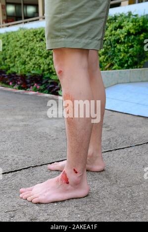 Gambe umane con fresca abrasione avvolta dall'incidente Foto Stock