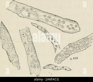 Un trattato sulla luminosa della malattia e il diabete, con particolare riferimento alla patologia e therapeuticsIncluding una sezione sulla retinite in luminose della malattia . calchi, epiteliale getta, sangue-calchi, olio-getta, waxycasts, e granulare di cast. Di quest'ultimo ci sono due sotto-divisioni,-l'jiale o moderatamente granulare ed il darkgranular cast. Per quanto riguarda il materiale di cui sono com-poste diverse viste sono detenuti. In primo luogo mi presente mio,perché mi permetterà allo stesso tempo e in briefestmanner per descrivere le diverse varietà. In primo luogo tutti i getti non sono della stessa Campos Foto Stock