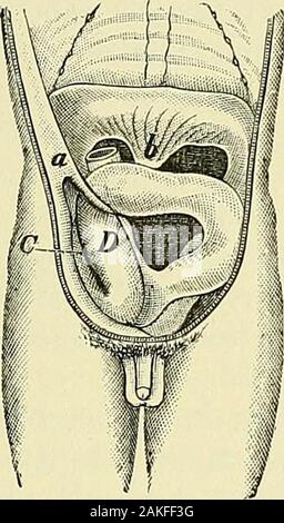 Un manuale per la moderna chirurgia : una esposizione delle dottrine accettato e approvato le procedure operative del tempo presente, per l'uso degli studenti e dei professionisti . s, che ha luogo al di sopra il sedile di ostruzione, è talvolta percepito dalla palpazione. È aptto essere sul lato destro dell'addome e può essere dentellata o buca- ostruzione intestinale. 635 ted dalle dita premuto all'esterno. Questo sintomo è almostpathognomonic. Invagination può avvenire senza ostruzioni per thepassage delle feci. Di solito il gonfiore delle mucose e provoca othercoats obliterazione del lume Foto Stock