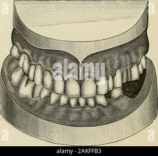 Un pratico trattato sulla corona artificiale- e ponte-lavoro . Fig, 373.. Ampia corona- e BR I ROSSI-lavoro. 183 rimanendo superiore ed inferiore dei denti naturali non aveva alcun corrèze-sponding antagonisti, causato tlie incastro e ahnor-mal condizione in materia di occlusione mostrata. Il superiorright bicuspid, sinistra, centrale e sinistra canini sono stati incoronati. La fio. 374. Foto Stock