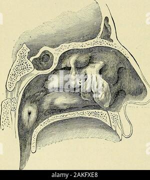 Un manuale per la moderna chirurgia : una esposizione delle dottrine accettato e approvato le procedure operative del tempo presente, per l'uso degli studenti e dei professionisti . ther cavi-cravatte collegato con thenose. Essi seldomgrow dal tetto orseptum del nasalchambers, sono generalmente coperti con epitelio ciliate e aremultiple, sebbene uno o due del gruppo supera generalmente theothers dimensioni. Nella forma, essi possono variare dalla forma globulare al pyri-forin o forma ovoidale. I sintomi di ostruzione delle vie respiratorie dovuta alla condizione causesa cambiamento nel tono di voce, giviug è il cosiddetto Foto Stock