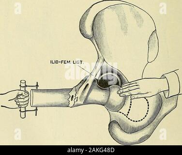 Un manuale per la moderna chirurgia : una esposizione delle dottrine accettato e approvato le procedure operative del tempo presente, per l'uso degli studenti e dei professionisti . Riduzione di un indietro la lussazione dell'anca da upwardtraction sulla gamba che è piegata ad angolo retto. (Fino a- MANNS.) Fig. 308.. Diagramma che mostra la prima fase del metodo Alliss di ridurre in avanti dislocazioni del femore compli-cato con frattura, ^llis. ) Feriti estremo in alto verso il soffitto ; egli accende poi il leginward per causare la rotazione verso l'esterno della coscia e porta infine theleg e coscia all'interno. Foto Stock