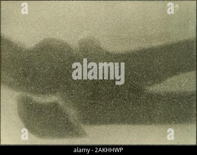 Un manuale per la moderna chirurgia : una esposizione delle dottrine accettato e approvato le procedure operative del tempo presente, per l'uso degli studenti e dei professionisti . il divario esistente tra l'albero ulnare e olecranon,probabilmente hanno un influenza nel causare la separazione dei frammenti. I sintomi sono il dolore localizzato e gonfiore, la mobilità laterale, andcrepitus, combinato con più o meno la perdita di energia per estendere la fore-braccio e con, in alcuni casi, una notevole depressione in corrispondenza della sede di28 434 fratture frattura. Gli ultimi due sintomi variano notevolmente con il grado oflaceration del envel fibroso Foto Stock