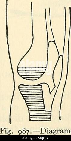 La moderna chirurgia generale e operativo . Fig. 986.- -rappresentazione schematica di Grit-tis funzionamento.. Foto Stock