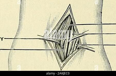Un manuale per la moderna chirurgia : una esposizione delle dottrine accettato e approvato le procedure operative del tempo presente, per l'uso degli studenti e dei professionisti . Tibiale ANTERIORANTERIOR NERVEANTERIOR tibiale arteria tibiale estensore PROPRIUSHALLUCIS tibiale anteriore tibiale ARTERYANTERIOR nervo. Estensore HALLUCISTENDON PROPRIUS di estensori DIGITORUM LONGUS MUSCOLO-nervosi cutanei relazioni chirurgiche dell'anteriore arteria tibiale della gamba destra. (Kochbk.)-arteria che è più vicino al malleolo ; il tendine del flessore lungo dell alluce dietro di essa e più profondo. Di tanto in tanto l'arteria bifurc Foto Stock