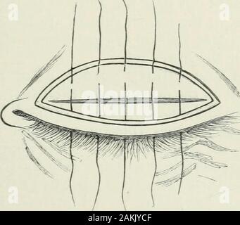 Atlas e la quintessenza della oftalmologia operativa . , Theedge della pelle-muscolare avvolto viene minata solo come faras le ciglia. Se il tarso non è anormale è lasciata intatta toremain; ma se è piegato e addensato il entirestructure, compresa la congiuntiva (che è, per quanto riguarda la piastra thehorn), deve essere suddivisa in una direzione perpendicularto la sua superficie (Fig. 132). Gli aghi sono così introducedas prima di cogliere il aponeurosis e il bordo superiore delle operazioni per ENTROPION. 319 tarso; sono poi passati al di sotto del labbro inferiore della ferita e portato fuori immediatamente dietro la eilia.Al Foto Stock