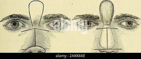 Un manuale per la moderna chirurgia : una esposizione delle dottrine accettato e approvato le procedure operative del tempo presente, per l'uso degli studenti e dei professionisti . Profilo del lembo preso dal labbro superiore per recon-struction di ala del naso. Fig. 66.. iKiik^J^s Mostra profilo di sportellini per rendere il ponte nasale mostra il lembo frontale rivolta verso il basso sotto thehigher. (Stimson.) lembi laterali. La superficie grezza sul fronte è lasciato al granulato o coperto con trucioli di pelle.(Stimson.) e altre funzioni di deformate sono migliorate variano con il carattere della distorsione.1 1 Vedi autori monografia sulla cura Foto Stock