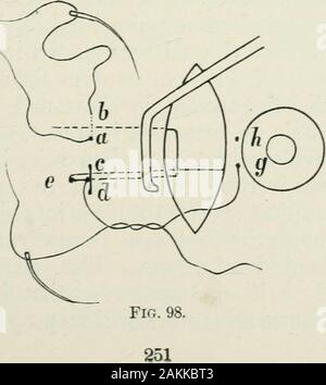 Atlas e la quintessenza della oftalmologia operativa . 252 interventi sull'occhio. con una singola sutura (Fig. 98, 6) e disegno si halfwaythrough, in modo che l'ago è al centro della sutura.Le estremità della sutura sono poi nuovamente fornito withneedles. Dopo la metà la sutura è stata introducedthrough il tendine e la congiuntiva da scleralside, l'ago viene tagliata in modo che, invece di Webersloop, ci sono a sinistra due estremità libere emergente dal ten-don e la congiuntiva. Questi due estremi sono quindi legati conla altre estremità della sutura, che sono state passedthrough congiuntiva, sopra e Foto Stock