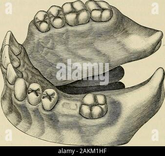 Un pratico trattato sulla meccanica odontoiatria . rendering disponibile themuscles del palato naturali per controllare i movimenti delle arti-ficial palato. I requisiti essenziali di un palato artificiale sarà quello di ripristino,per quanto possibile, la forma naturale a organi difettosi con suchmaterial come deve ripristinare le loro funzioni. Potenza muscolare, certamente, non può essere dato per un pezzo del meccanismo, ma il materiale e formmay essere tale che esso porterà a e di essere sotto il controllo di themuscles circostante, e quindi misurabile conferiscono ilfunzionamento dell'organo che si rappresenta. Fig. Foto Stock