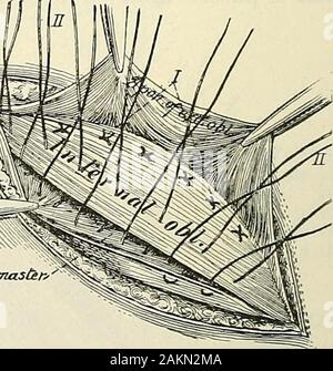 La moderna chirurgia generale e operativo . Fig. 743- -sutura di cremaster al mtemaloblique (Halsted). Cremastkn- Fig. 744.-la sutura del bordo inferiore del internaloblique a Pouparts Ugament (Halsted). Il passo successivo è quello di portare il lembo inferiore, composta di cremaster andfascia muscolare, sotto l'interno del muscolo obliquo e sutura (Fig. 743). La sutura Wenext interna del muscolo obliquo e ricollegate il tendine di Pou-parti legamento, il bordo inferiore del obhque interna essendo nascosto sotto il bordo del legamento (Fig. 744). Per fare ciò potrebbe essere necessario per il rilascio Foto Stock