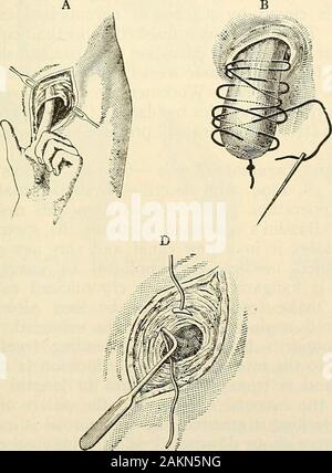 La moderna chirurgia generale e operativo . Fig. 732.-A, incernierato direttore dell'ernia;B, ernia aghi.. Foto Stock