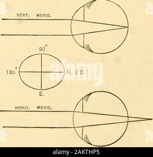 La rifrazione del occhio; compreso un trattato completo su opthalmometry; una clinica libro di testo per studenti e professionisti . è,come una regola (forse nel 75-80 per cento di tutti i casi di astigma-tism), più curve di quella orizzontale o il meridiano a rightangles, l'astigmatismo in tali casi è detto essere accord-ing per la regola o con la regola. Gli scrittori francesi spesso callthis astigmatismo diretto, mentre essi designano astigmatismagainst la regola come astigmatismo indiretto. Molte volte i principianti chiedere se hypermetropic astigmatismo nonè sempre con la regola e se astigmatismo miopico ho Foto Stock