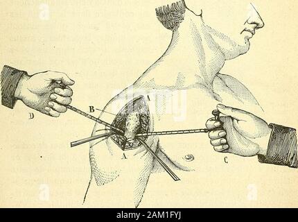 Chirurgie journalière des hopitaux de Paris : répertoire de thérapeutique chirurgicale . facilement à saisir ce petit corps saillant (duncentimètre et demi environ) et à lui imprimer des mouvementsassez étendus dans le sens : verticale su pouvait même le faire bas-culer en avant et le coucher sur la face antérieure du sterno, maissans arriver à le faire basculer en arrière. M. Polaillon chercha àplusieurs ha ridiscusso à réduire cette lussazione, mais ayant échoué etayant occasionné dassez vives douleurs, il ninsista pas et n:eut pasrecours (Je crois avec raison) à cet expédient que Billard (cité par Foto Stock