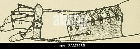 Terapia medico-chirurgica . Maiale. 36.-Apparecchio per la correzione dei disturbi muscolo-spirale paralisi(vista frontale). 38) è di un analogo del design ma può essere bloccato, thehand rimanendo leggermente hyperextended per consentire heavyobjects per essere afferrata; è un buon apparato forworking con.^ altri ugualmente pratico apparecchi sono quelli ofPrivat e Belot (figg. 39 e 40), Leri e Dagnan-Bouveret (fig. 41), Mouchet e Anceau, Riefiel andRipert. La Commissione ha nominato dal 1 neurologiche Beviie Neurologique^ luglio 1916, p. 123, 336 di trattamento e la riparazione delle lesioni nervose Società a indagare protesico per appl Foto Stock