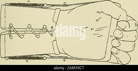 Terapia medico-chirurgica . Fig. 35.-Apparecchio per la correzione dei disturbi muscolo-spirale paralisi(applianceat resto). (A. Souques, M6gevand e Donnet.) i movimenti di flessione su base volontaria e meccanica ex-tensione può quindi avvenire liberamente (figg. 35 e 36).L'apparecchio di Froment e Muller (figg. 37 e. Maiale. 36.-Apparecchio per la correzione dei disturbi muscolo-spirale paralisi(vista frontale). 38) è di un analogo del design ma può essere bloccato, thehand rimanendo leggermente hyperextended per consentire heavyobjects per essere afferrata; è un buon apparato forworking con.^ altri ugualmente pratico apparecchi sono quelli ofPrivat un Foto Stock