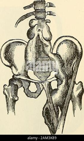 La moderna chirurgia generale e operativo . e raggiunge la surfaceby passando tra i processi trasversali. La questione tubercolare fromdorsal carie può eseguire in avanti tra i muscoli intercostali o betweenthese muscoli e la pleura, puntando in un spazio intercostale in corrispondenza del lato di thesternum, o dal muscolo retto. Potrebbe scoppiare in gola, windpipe,bronco, pleurico sac, pericardio o. Si può scendere al diaframma andtravel sotto l'interno legamento arcuato in modo da formare un ascesso psoas o sotto theouter Hgament arcuata per formare un ascesso liunbar. Un ascesso psoas possono pointabove Poupart Foto Stock