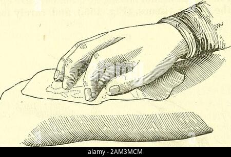 Nuovi elementi di chirurgia operativa . come in un cerchio, aroundits circonferenza. Ma usiamo, generalmente, la mano, purché conun pezzo di biancheria, invece del vetro di cui ho appena parlato.le sanguisughe vengono quindi raccolti in un impacco, al fine di ap-velo loro immediatamente di tegumenti, in modo asto mantenere la biancheria moderatamente pressato attorno a tutta quella parte di theskin che le sanguisughe occupano, (Fig. 156.) Se questa precauzione werenot presi le sanguisughe sarebbe presto escape e sarebbe perso bycreeping circa in tutte le direzioni. La cuvetta di piccole dimensioni di filo di argento, informare di un uovo-stand, che Foto Stock