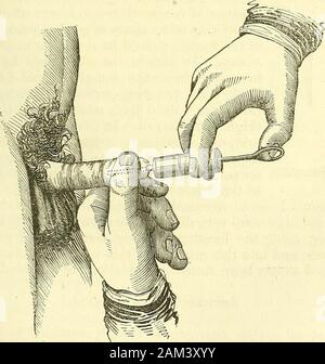 Nuovi elementi di intervento chirurgico . Canta. 223 per iniettare tra i coperchi e occhio, è meglio utilizzare una ^^s- ^?&GT;piccolo sifone siringa, leggermente conica, come theurethral siringa, (Fig. 139.) per il naso e la bocca, ifwe*v.ish di iniettare abbondantemente, abbiamo bisogno, talvolta, ofa sjTinge di maggiori dimensioni. La stessa osservazione si applica fo ab-scesses e fistulous passaggi in tutte le regioni di thebody. Se la cavità di essere lavato è molto la.RWI, abbiamo haverecourse per un clistere siringa. Iniezioni di l'uretra sono realizzati con siringhe a containabout un oncia di liquido, (Fig. 140 ;))))) il sifone portio Foto Stock