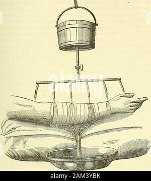 Nuovi elementi di chirurgia operativa . stagno, è fissata in prossimità del fondo del recipiente;il tubo o i tubi sono prolungate a livello con la parte malata, in mododa permettere l'acqua contenuta nel serbatoio (Fig. 137) a cadere uponit goccia a goccia o in un minuto di flusso. Se la parte malata è verycircumscribed, un singolo tubo sufficiente. In caso contrario, weincrease il numero più o meno, in modo da non lasciare tra themmore di tre a quattro pollici, in modo tale che il liquido può fallwithout interruzione sui principali punti inffamed. Per ottenere da questo trattamento ogni possibile vantaggio, esso isne Foto Stock