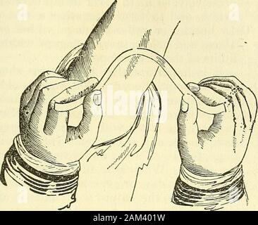 Nuovi elementi di intervento chirurgico . ^ staccando le loro estremità; abbiamo poi separarli fino ai bordi della thewound, da quale parte essi devono essere rimossi per ultimo e da un per-pendicular trazione, per paura di disturbare l'Unione, che come yethas ma scarsa solidità, (Fig. 133.) Questa precauzione becomeuseless sarebbe se fosse stato impiegato per tenere il panno, comprime,o altra porzione della fasciatura nel carattere di un containingbandage. Vari tipi di medicazioni.(Fig. 133.) 207. § II.-inglese, Court-Plaster (taffetas.) nel trattamento di piccole e ferite superficiali, e quando vogliamo todis Foto Stock