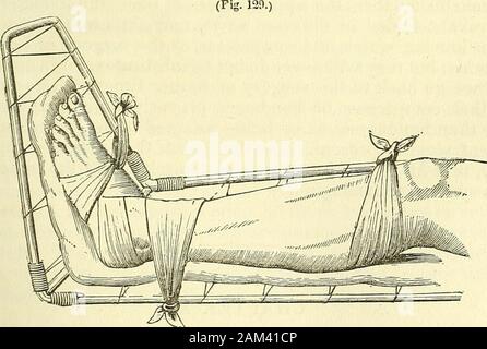 Nuovi elementi di chirurgia operativa . Sono fastenedthe due estremità del triangolo che abbraccia il gomito o theknee. È anche facile da capire come cataplasmi, sinapisms, andblisters, possono essere supportati su diverse regioni degli arti damezzi di fazzoletti e cravats. Essa è la modalità instinctivelyfollowed da tutto il mondo in generale e che M. Sindaco ha preso come punto di partenza per il suo intero sistema di bendaggio, {deli-chiesta.) articolo X.-Uniting bende. Ciò che ho detto del fazzoletto, come un bendaggio che unisce inhare-labbro, o ferite del labbro superiore, mostra anche che potremmo,i Foto Stock