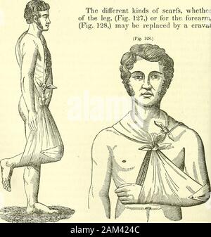 Nuovi elementi di intervento chirurgico . (Fig. 127.) articolo IX.-sciarpe. I diversi tipi di sciarpe, whetherof la gamba, (Fig. 127), o per l'avambraccio,(Fig. 128) può essere sostituito da un cravat. Medicazione provvisoria per le fratture. 199 e un fazzoletto, nella forma di un triangolo. Abbracciando in questo uomo-ner la nuca, il cravat dovrebbe essere legato al lato o sullaparte anteriore del torace. Esso rappresenta quindi un anello a V^^hich sono fastenedthe due estremità del triangolo che abbraccia il gomito o theknee. È anche facile da capire come cataplasmi, sinapisms, andblisters, possono essere supportati su differenti Foto Stock