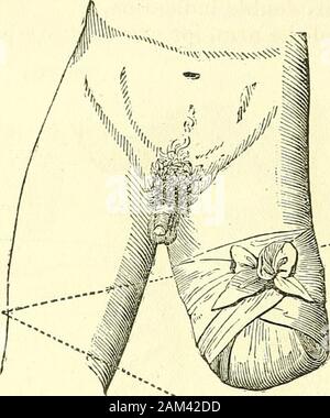 Nuovi elementi di chirurgia operativa . non ci sarebbe nulla da fare, ma a sollevare da dietro per-Ward, e dal basso verso l'alto, il punto del fazzoletto (FIG.126), in modo da fissarla al cerchio formato dalla base di thebandage. Regolato in questo modo la benda per amputazioni è ex-estremamente semplice. Come si richiede solo per sganciare e abbassare la pointof per scoprire la ferita, la medicazione potrà essere rinnovata wdthoutcausing il minimo movimento per il moncone. Ciò che ho appena detto di amputazione della coscia, è applicabiliai amputazioni della gamba e del piede del braccio e avambraccio. Ho willonly aggiungere, Foto Stock