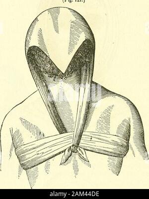 Nuovi elementi di intervento chirurgico . Se questo tipo di lesioni richiedono un certo grado di solidità in thewidth del bendaggio, non vi è nulla di più facile che per regolare dopo 25 194 NUOVI ELEMENTI DI CHIRURGIA OPERATIVA. la maniera di M. Mayor, un pezzo sottile di cartone o di coarsepaper tra le pieghe del fazzoletto di uniting, dividendo, e raddrizzatura {redresseurs) bende,per il collo, sono realizzati per mezzo di un fazzoletto, medio partedella che è posto sul vertice, (Fig. 120) se è necessario in-cline la testa in avanti; sul fronte (Fig. 121) al contrario Fig. 121.). cas Foto Stock