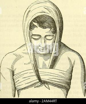 Nuovi elementi di intervento chirurgico . Articolo IV.-bendaggi per il collo. Le medicazioni ordinario per il collo sono realizzati da un collo mano-fazzoletto, {moucfioir en cravate ;))))) questa è stata la prassi per agea (Fig. 120.). Se questo tipo di lesioni richiedono un certo grado di solidità in thewidth del bendaggio, non vi è nulla di più facile che per regolare dopo 25 194 NUOVI ELEMENTI DI CHIRURGIA OPERATIVA. la maniera di M. Mayor, un pezzo sottile di cartone o di coarsepaper tra le pieghe del fazzoletto di uniting, dividendo, e raddrizzatura {redresseurs) bende,per il collo, sono realizzati per mezzo di un han Foto Stock