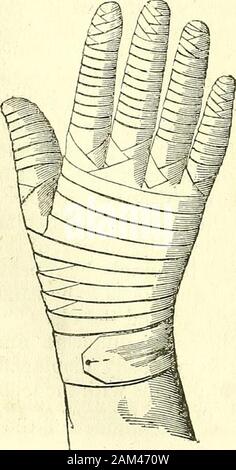 Nuovi elementi di chirurgia operativa . d che vi partecipano. Le dita hanno un tipo di bendaggio adaptedonly a loro e porta il nome di sfida, presentando twovarieties: the gauntlet propriamente detta e la demi-sfida. A. il guanto della sfida, (gantelet,) (Fig. 114.) Lo scopo della sfida è di surroundeach dito con un tipo di bendaggio rullo.It è sempre utile quando vogliamo makea certo grado di pressione, orcurative preventiva, su ciascuna delle dita separatamente.Un modo di fare ciò che ho foundvery conveniente, è come segue : prendere un divieto-dage di circa un pollice o uno finge Foto Stock