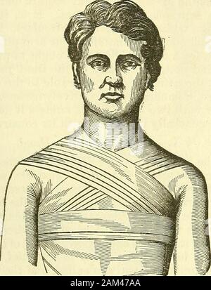 Nuovi elementi di intervento chirurgico . Bende. 179 su ogni lato quello che mi hanno detto di uno di essi. Il rullo bandagewith due teste di laminati, che era precedentemente impiegato per questo scopo,è del tutto inutile ; i chirurghi della presente giornata sono per la maggior parte,soddisfatto con il bendaggio con una testina per i diversi tipi ofspica possono avere occasione per l. C. Il Stellated, (etoile-Fig. 113.) il bendaggio stellated asort è di figura 8, attraversata nella parte anteriore del t^e torace e associati (Fig. 113.). alcune spire di spica. Thillaye descrive tre varietà di it-thesingle stellated, la doppia stel Foto Stock