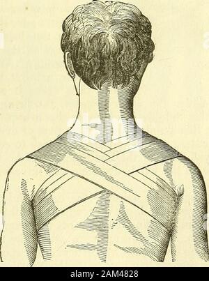 Nuovi elementi di chirurgia operativa . tra la scrctum ela coscia destra al fine di fissarli mediante una Jtnot o da perni di thecincture sopra l'inguine. Il bendaggio triangolare, che è stato utilizzato precedentemente per certainwounds nel quartiere dell'ano, e che è in frequentuse attualmente per le malattie della regione inguinale, (Fig. 110) è infatti lo stesso di quello di cui ho parlato nel segnalare thebandages per la regione mammaria. È pertanto inutile torecur a qui. § IX.-bendaggi per la parte superiore degli arti. La parte superiore del braccio è soggetto a molte malattie, Foto Stock