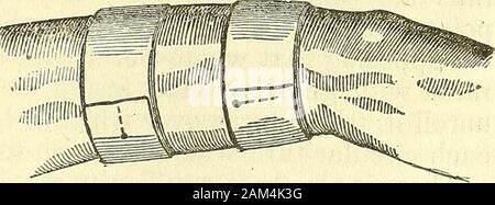 Nuovi elementi di intervento chirurgico . (Fig. 81.) (Fig. 80.). 142 NUOVI ELEMENTI DI INTERVENTO CHIRURGICO. Io supponi che stiamo trattando la estremità inferiore. Abbiamo mustprocure un bendaggio di lunghezza adeguata, arrotolato in un cilindro, threefingers ampia, a secco o a umido secondo la indicazione e iniziare bysurrounding il piede. Se il chirurgo è accompagnato byassistants, uno di essi detiene il tacco veloce con una delle sue mani,e l'estremità digitale del piede con gli altri, mentre un secondassistant, poste in prossimità del bacino del paziente, supporta il prosciutto,o la parte inferiore della coscia, in modo che il Foto Stock