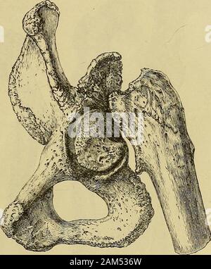 Un sistema di chirurgia . s, impedire che essa fromgoing più lontano, andsling il corpo dalla parte superiore del femore;il collo rifiuti anddisappears (Fig. 274),e la testa in theacetabulum generallyrests contro la femurin il neighborhoodof il piccolo tro-chanter. Raramente si accumulano di osso nuovo isthrown fuori dall'osso iliaco come una sorta di presa contro la quale il trocantere può giocare(Fig. 283). La zoppia risultati da queste lesioni, soprattutto da theununited intracapsular; ma con un elevato di avvio e un bastone anche thesepatients può ottenere circa abbastanza. A volte il peso non può essere borneone l'arto. 3. Frattura del grande trocha Foto Stock