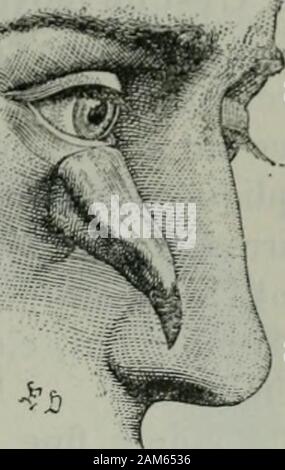 Traité de chirurgie . alité letissu cellulaire sous-cutané des paupières. La peau des paupières et ses allegati sont le siège de papidomes, dangiomes,de kystes. Dans le tissu cellulaire sous-cutané, a osservare le développement defibromes ei denévromes plexiforrnes, de hjmphangiomes, de lipomes, sans compterles trasformazioni de léléphantiasis et de la lèpre. Papillomes et verrues. - Lhypertrophie des papilles du derme et de lacouche épidermique qui les entoure se présente aux paupières avec des appa-rences difîérentes peu de celles des autres régions, mais elle y prend des pro-porzioni relativ Foto Stock