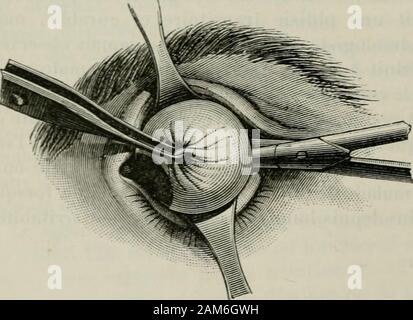 Traité de chirurgie . Ùlon détache Celui-ci. Ce tendonest alors saisi par les mors de lapince. Pour rendre plus aisée laluxation de loeil cl la sectiondu nerf optique, qui présententtoujours quelques difficultés,on peut aussi faire usage din-struments spéciaux, tels que lacuiller de Trélat. Lorsque le nerf optique estcoupé, le globe de loeil nestplus retenu que par quelquesadhérences provenant de linsertion des muscoli le oblique. Elles sont sezione-nées dun coup de ciseaux. La modifica suivante a été proposée par Tillaux pour lénucléalion deloeil. Il coupe dabord linsertion muscolo du droit ext Foto Stock