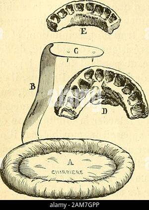 Chirurgie journalière des hopitaux de Paris : répertoire de thérapeutique chirurgicale . e haut en bas sur la tranche avec les doigts, jusquà ce quonne soit séparé de la Couronne des dents que par une tritare cou-che de sostanza gommeuse, su rapproche les mâchoires et lonfait sur le moule des iniezioni deau très-froide, ou bien oncharge le blessé daspirer leau à paisley tubo dun et den dirigerle courant sur lappareil ; en quelques minuti la guttaperca arepris sa consistance, sul ritiro le moule que lon façonne avec uncouteau et en lui laissant lépaisseur nécessaire pour conserver unerésistance Foto Stock
