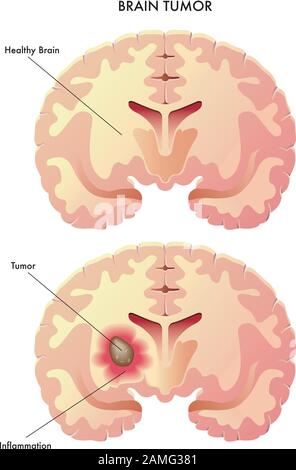 Illustrazione medica degli effetti del tumore cerebrale. Illustrazione Vettoriale