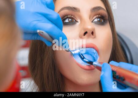 Restauro odontoiatrico in odontoiatria con lampada in fotopolimero. La ragazza all'appuntamento del dentista. Primo piano della cavità orale Foto Stock