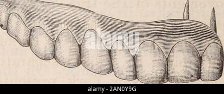 Cosmo dentale . sequentemente molto scarsa nomenclatura per un caso come questo, e teword selle sarebbe meglio esprimere la nostra idea. Fig. 3 mostra illavoro finito. In Fig. 4 il ponte è visto in posizione. . Dr.Rhein ha presentato anche una giovane signora, di circa ventidue anni, che la Fig. Due settimane fa aveva sostenuto una frattura del ramo destro della mascella inferiore come risultato dell'estrazione del terzo molar.She è venuto al Dr. Rhein due giorni dopo la frattura, sufferingseveramente da perdita di sonno, dolori neuralgici, gonfiore esteso andsfollamento. Il caso era così eccezionale che era FIRS Foto Stock