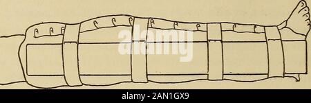 Il consulente medico di casa, un lavoro popolare sul trattamento della malattia. Rotto ci può essere solo un punto di tenera e gonfiore intorno alla vicinanza della rottura e nessun spostamento-mento o suono grattugiato. In caso di dubbio sull'esistenza di afracture, l'arto deve essere sempre trattato come se si presentasse una frattura. Lo scolorimento nero-e-blu della pelle, molto più moreesteso di quello che segue la pioggia, diventerà evidente su tutta la gamba entro ventiquattro ore. Trattamento.- Quando un chirurgo non può essere ottenuto, la seguente medicazione temporanea del cuscino, raccomandata da Scudder nelle sue fratture bookon, Foto Stock