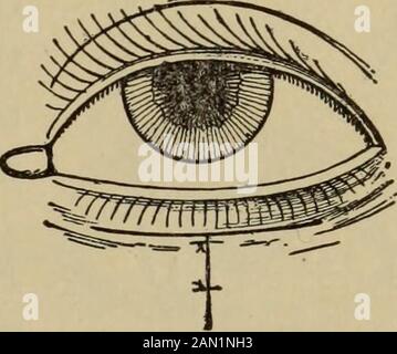 Testo-libro di oftalmologia . E Operazione per entropion con Metodo Von Graefes. Lo stesso dopo i bordi della ferita haveWay di fare l'incisione. È stato unito sufficientemente, sono uniti in una direzione verticale (Fig. 436; Von Graefe). Le cicatrici risultanti da questa operazione sono piuttosto più visibili di quelle risultanti dall'escissione di una striscia orizzontale di pelle, perché corrono perpen-dicular verso le pieghe cutanee; ma, d'altra parte, la thisoperation offre una maggiore sicurezza contro le recidive. 4. La Cantoplastica, poiché allevia il blefarospasmo, può anche essere impiegata per l'abr Foto Stock