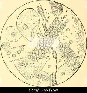 Moderna diagnosi e trattamento di malattie infantili; un trattato sulle malattie mediche e chirurgiche dell'infanzia. Nefrite acuta, ma, ad eccezione della differenza someslight nell'insorgenza (più improvvisa nella primaripite), la sintomatologia è praticamente la stessa nelle varietà di bothvaries. Il bambino lamenta mal di schiena, mal di testa, nausea e freddo, occasionalmente vomita, e, in forme gravi, mostra (117) 448 MALATTIE DEI RENI, VESCICA. Ecc Albuminuriaand casts. Altri sintomi di grave perturbazione costituzionale. Non infrangere-quently l'attenzione alla malattia non è attratta Foto Stock