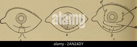 Testo-libro di oftalmologia . Fig.,419. - Operazione per un SymblefaronPosterius. [Fig. 420.-operazioni per Symblefaron. (Dopo Knapp in Norris e Oliver.) A. Arlts secondo metodo usato quando la cornea è invasa su (pseudo-pterygium). Quest'ultimo è staccato dalla cornea e dal bulbo oculare fino al fornice, e la testa di esso è cucita al fornice da un filo a doppia armata, che viene fatto passare attraverso il coperchio in modo da formare un'ansa sulla superficie cubana di quest'ultimo. Questo anello è legato su un rotolo di garza o un po' di tubo di gomma. La superficie della congiuntiva è coperta come mostrato in F Foto Stock